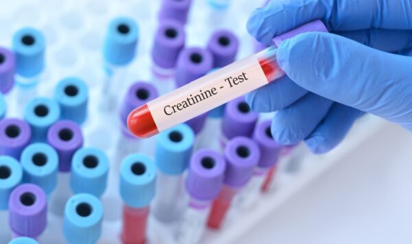 Doctor holding a test blood sample tube with Creatinine test on the background of medical test tubes with analyzes.
